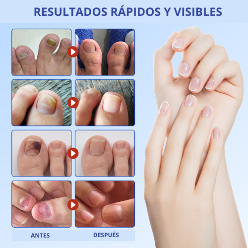 Parches para Hongos en las Uñas - ELAIMEI